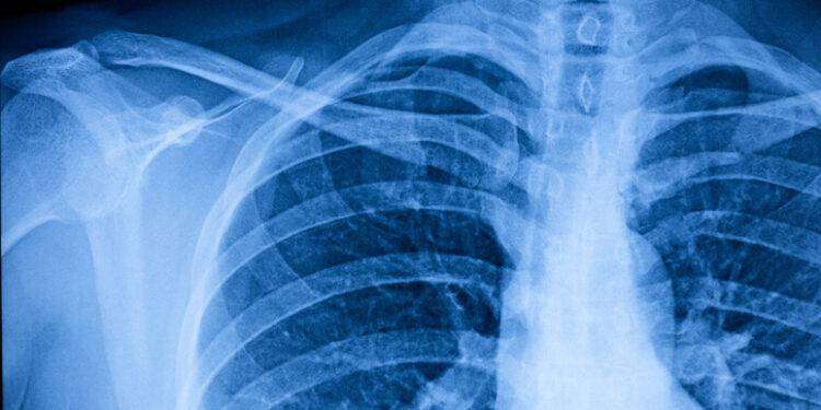 Non solo rughe, la vera età è scritta anche nel torace