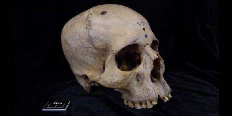 Segni di chirurgia dei tumori su un cranio dell’antico Egitto