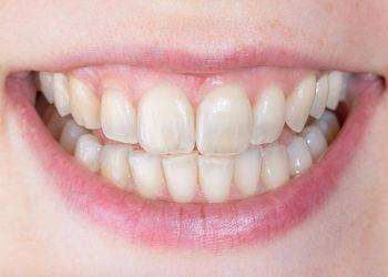 L’importanza di una corretta igiene orale per mantenersi in buona salute