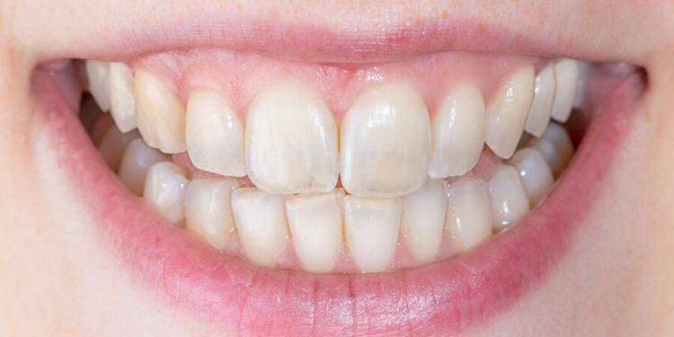 L’importanza di una corretta igiene orale per mantenersi in buona salute