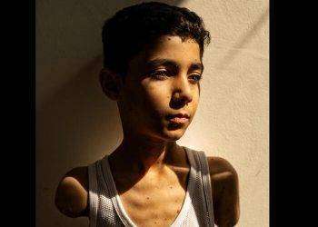 World Press Photo, il bambino amputato a Gaza è la foto dell’anno